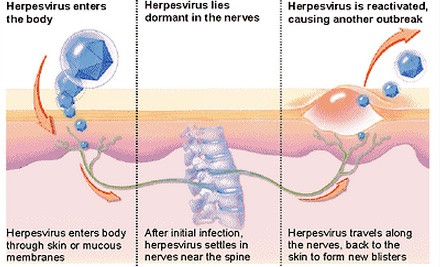 Herpes Virus