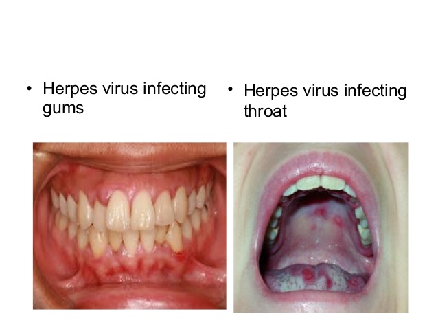 Herpes Virus