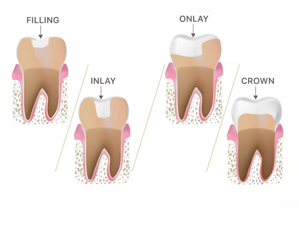 Diagram showing dental fillings, crowns inlays onlays