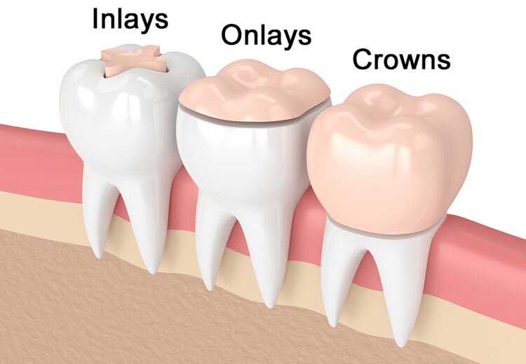 Inlays Onlays crowns