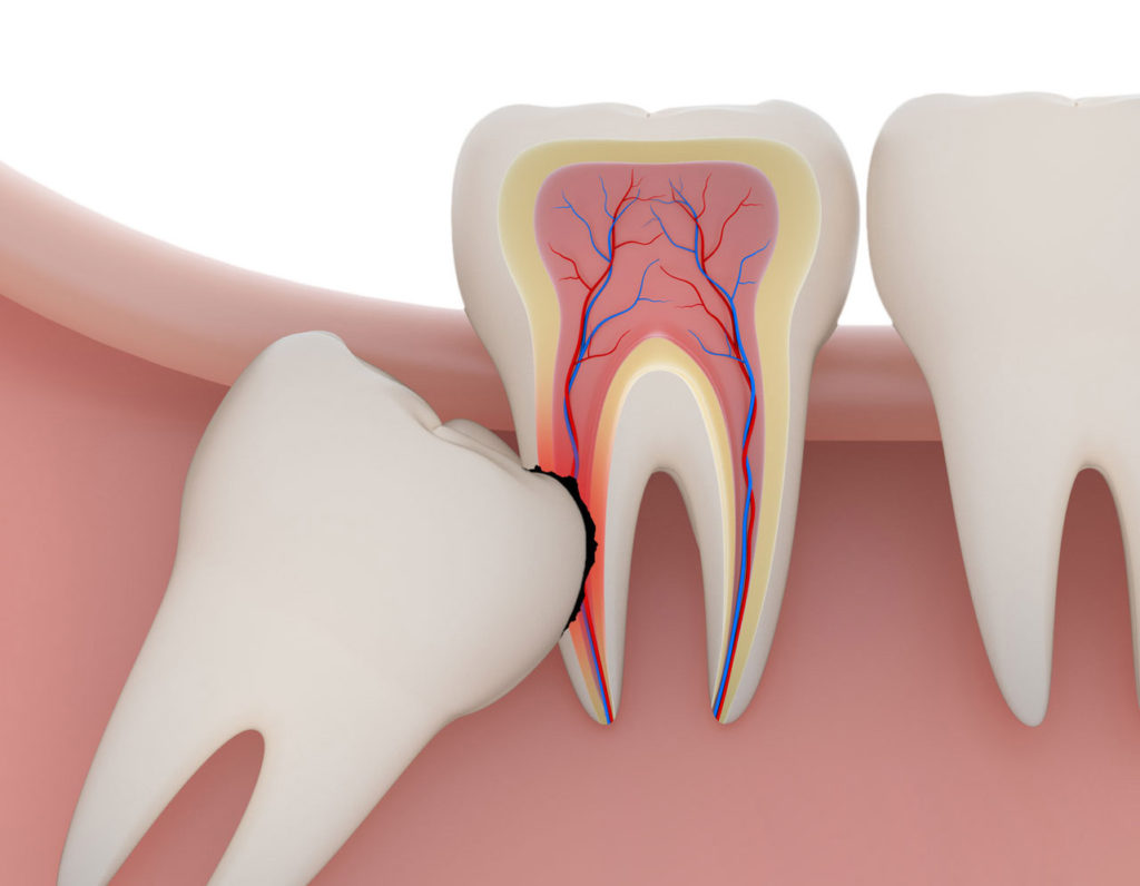 Diagram showing wisdom tooth
