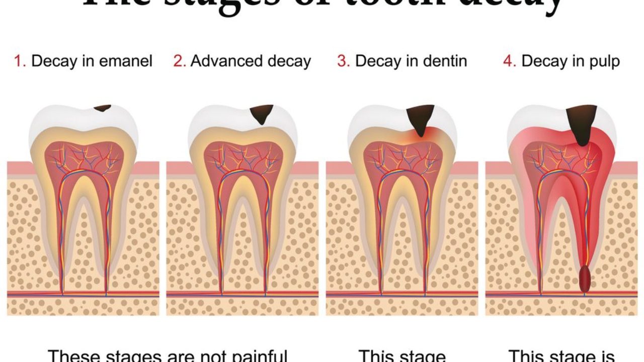 What is a Tooth Decay?