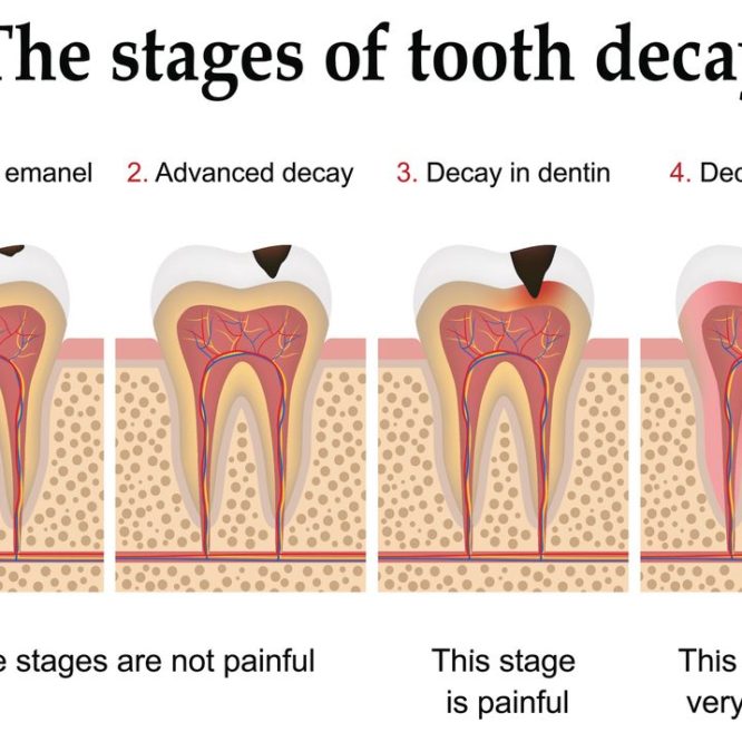 Tooth Decay stages & Cavities