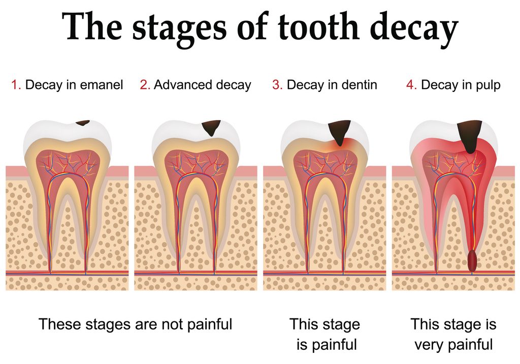 What is a Tooth Decay Dr Pascal Terjanian dentistry blog