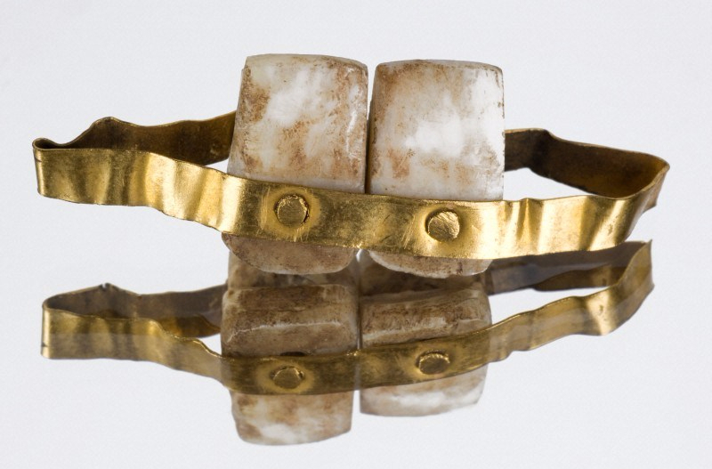 Etruscan Dentures led to modern dentistry