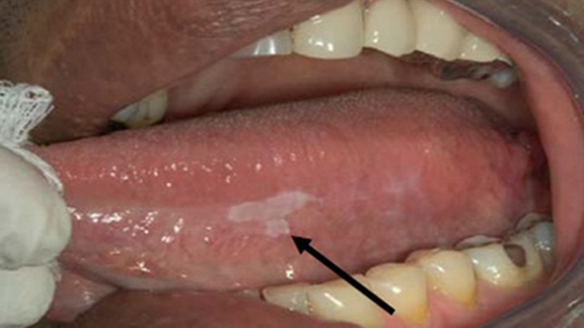 white patch on the tongue sign of oral cancer
