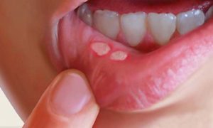 Blister on the lip sign of oral cancer
