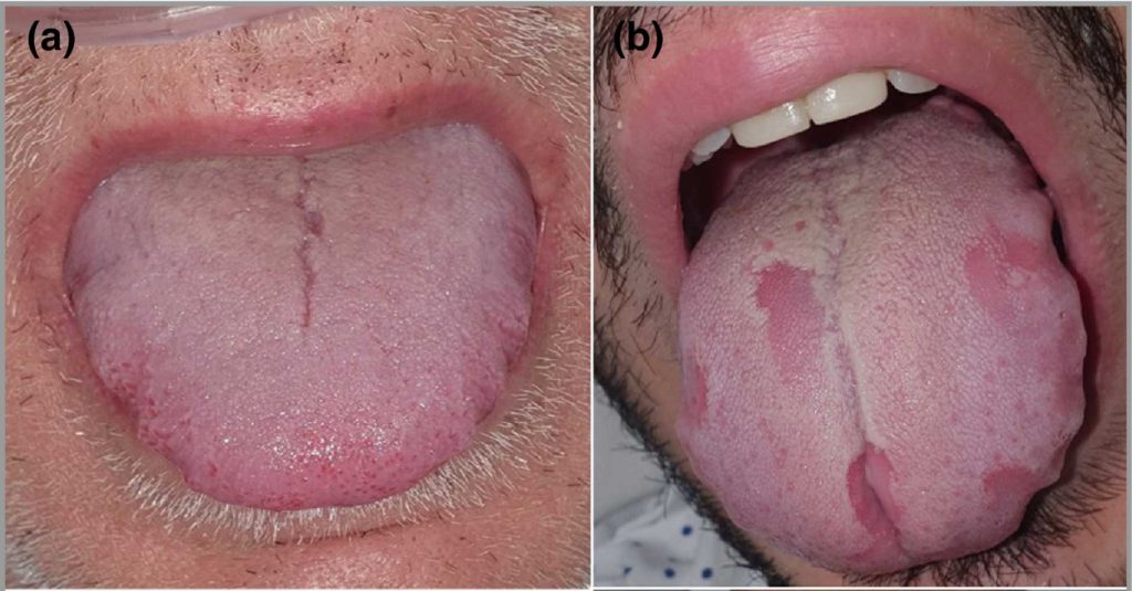 Covid tongue symptom Pascal Terjanian