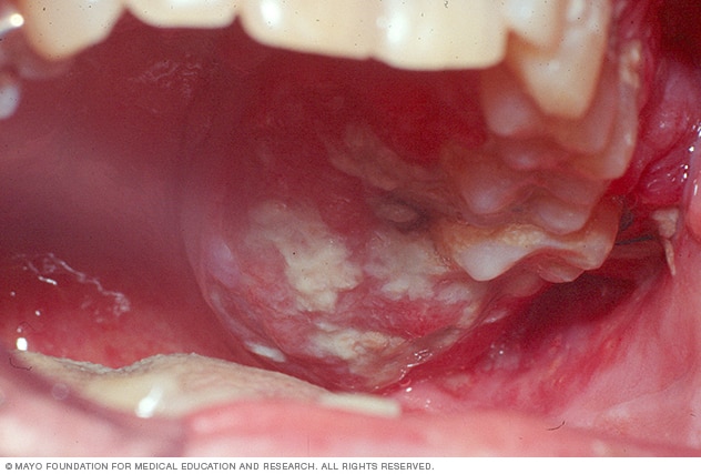 Oral Cancer