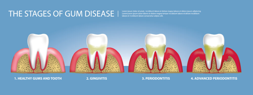 Stages of gum disease by Pascal Terjanian Dentist 