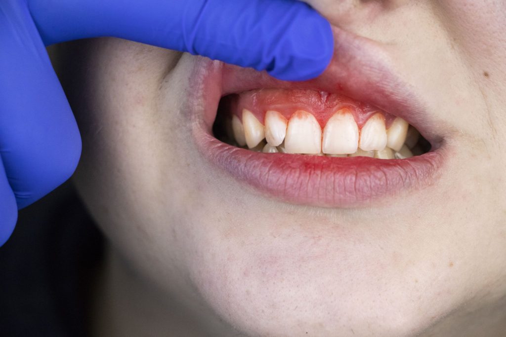 Swollen & red Gums are indication of gum disease