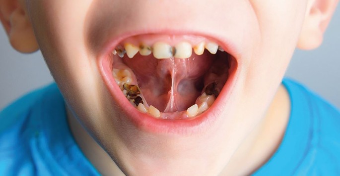 pascal-terjanian-dental-decay-in-children
